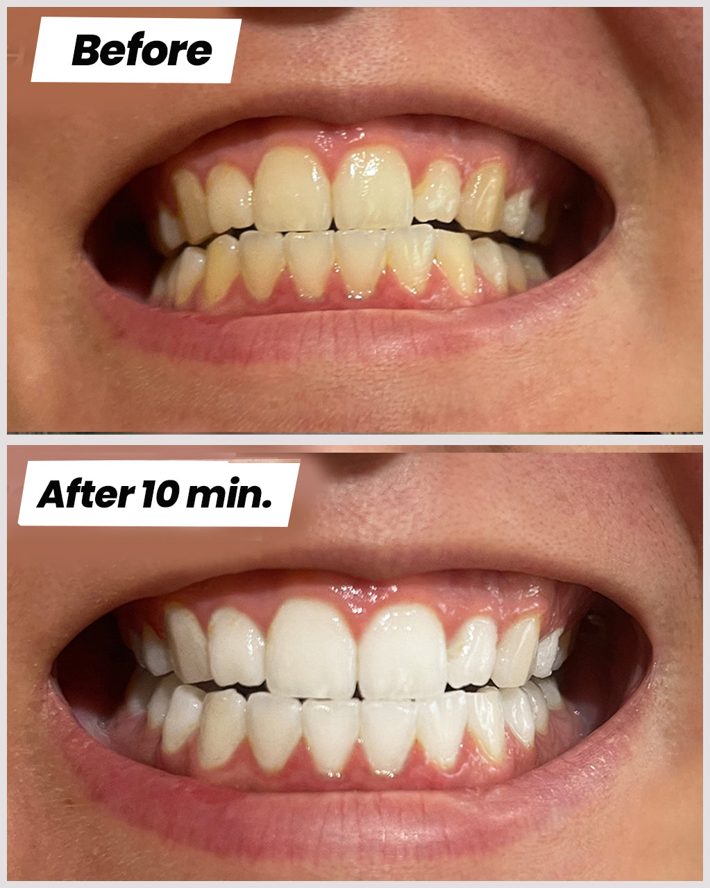 Teeth Whitening Strips™ - clicksmile.net 