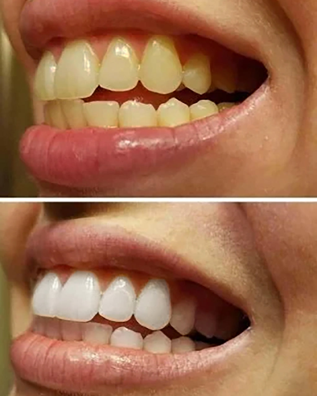 Teeth Whitening™ Strips